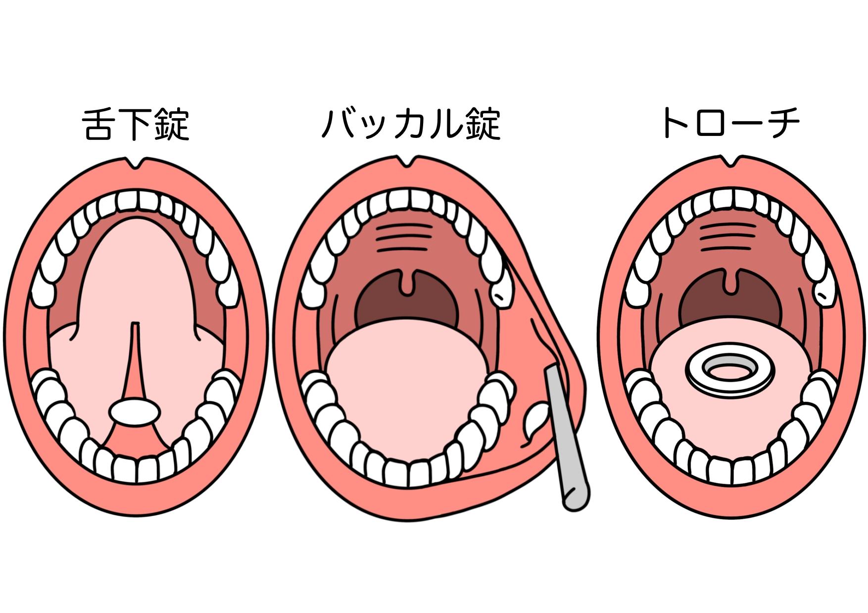 ニトロペン舌下錠は内服薬それとも外用薬?飲み込んだらどうなるの?薬剤師が調べてみました!